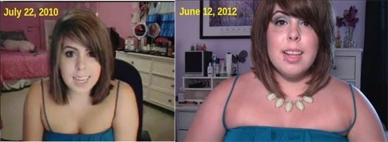 Weight Gain Before And After 7 - 31 Photos 