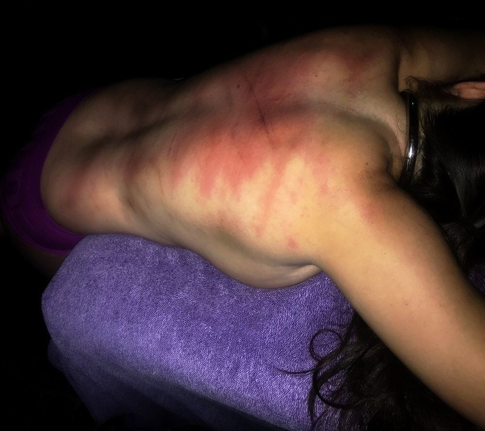 Healthy back with whip marks - 3 Pics 