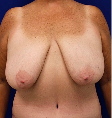 Breast reduction surgery after mastectomy-3705