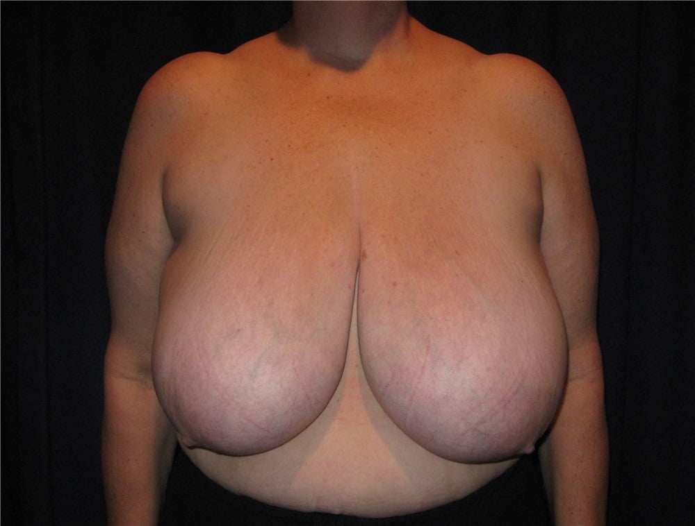 Top plastic surgeons for breast reduction-4149